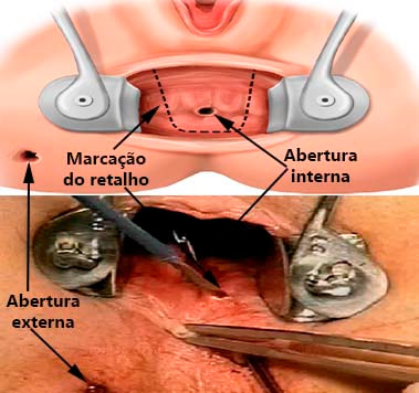 Cirurgia de fistula anal