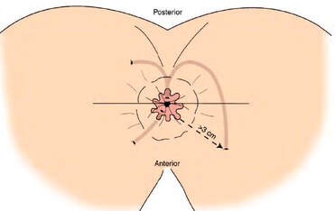 Fístula anal externa